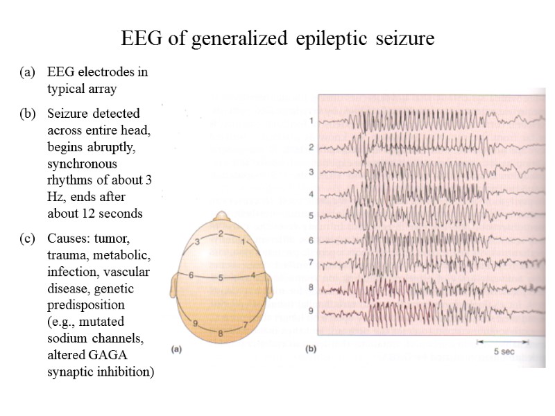 EEG of generalized epileptic seizure EEG electrodes in typical array Seizure detected across entire